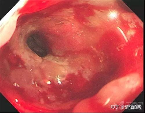 肠镜前吃瓜,轻松应对检查的小秘诀